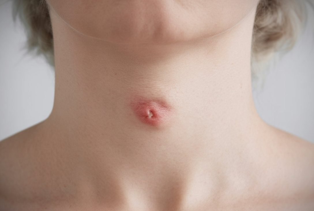 Pickel am Hals: Ursachen, Behandlung und Vorbeugung