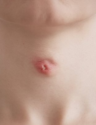 Pickel am Hals: Ursachen, Behandlung und Vorbeugung